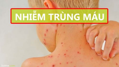 Mụn nhọt có thể biến chuyển thành nhiễm trùng huyết nếu không điều trị đúng cách